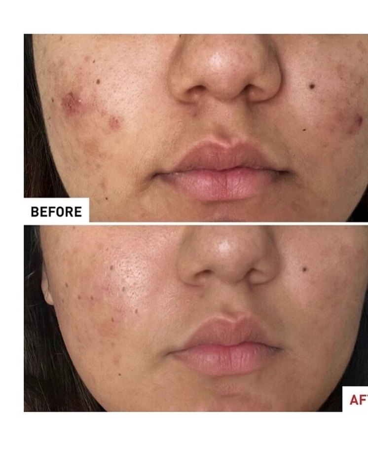 Erborian Centella Acné Care 30 ml - Görsel 3