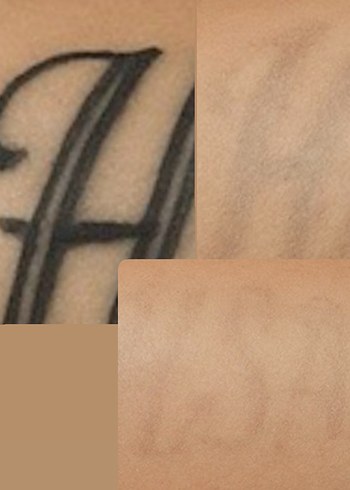 Lazer dövme silici - Görsel 4