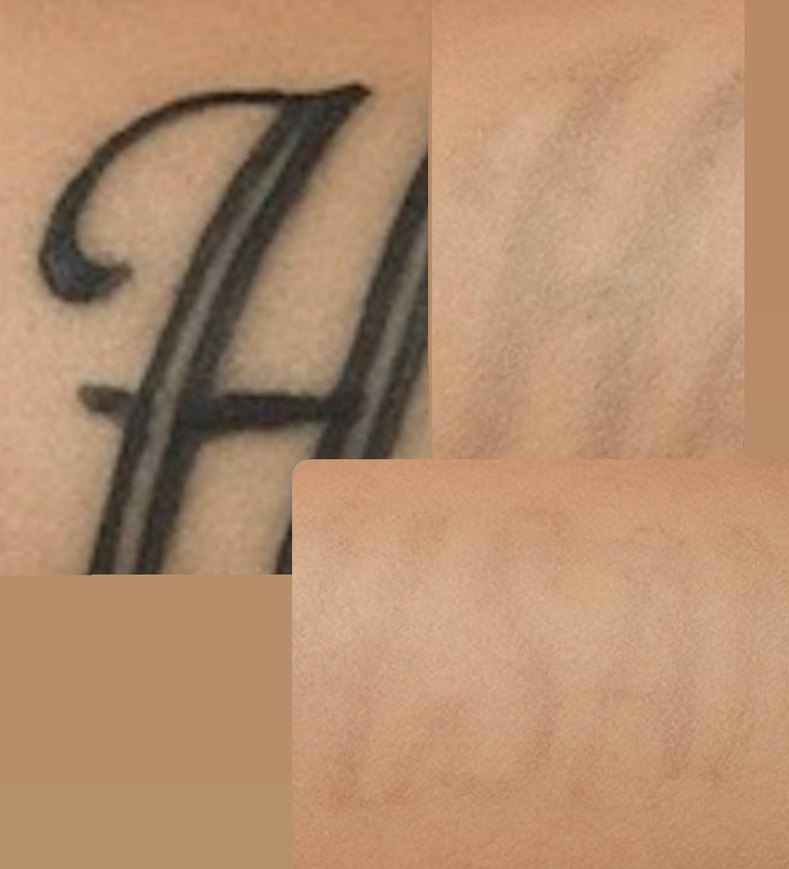 Lazer dövme silici - Görsel 4