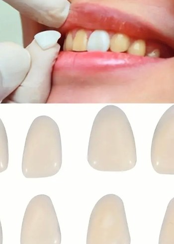 60lı ultra ince beyaz diş kaplaması - Görsel 2