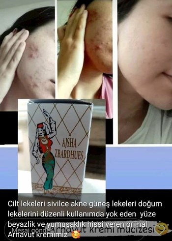 Aisha Cilt Lekesi ve Akne Kremi