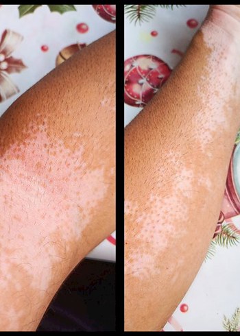 Vitiligo Egzama Kremi - Görsel 6