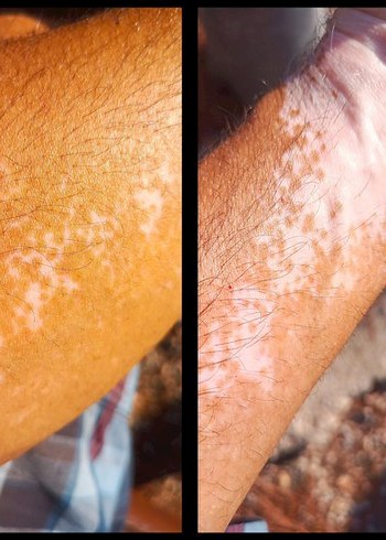 Vitiligo Egzama Kremi - Görsel 5