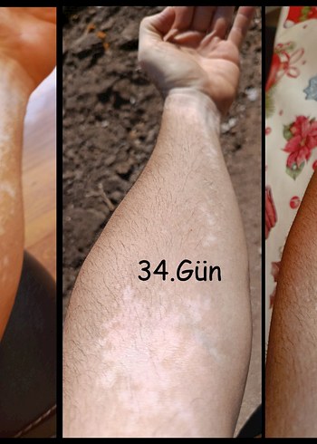 Vitiligo Egzama Kremi - Görsel 2