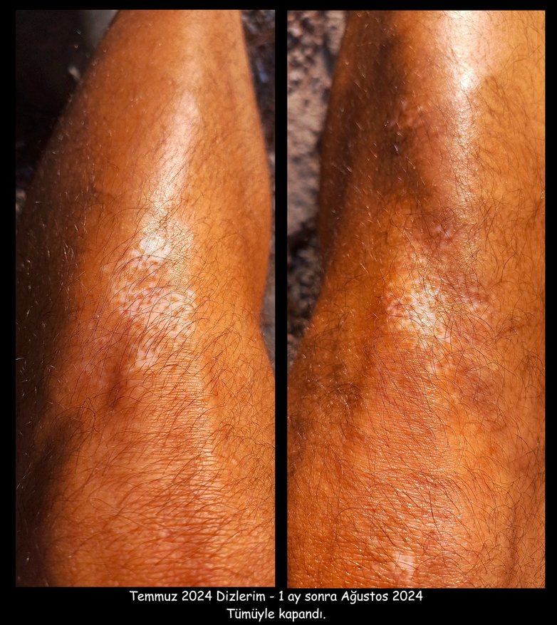 Vitiligo Egzama Kremi - Görsel 4