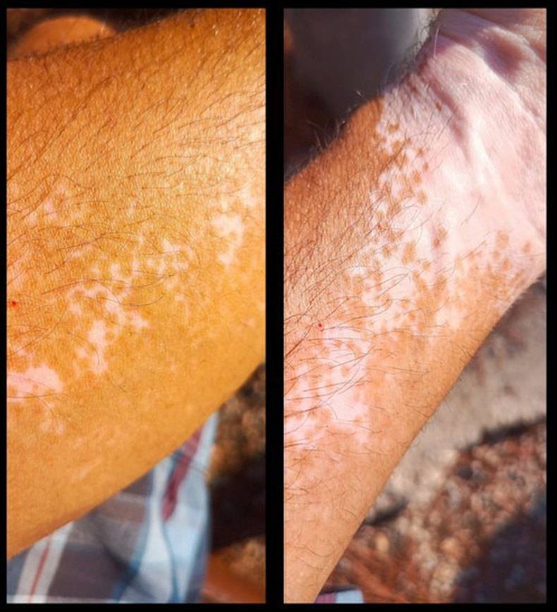 Vitiligo Egzama Kremi - Görsel 5