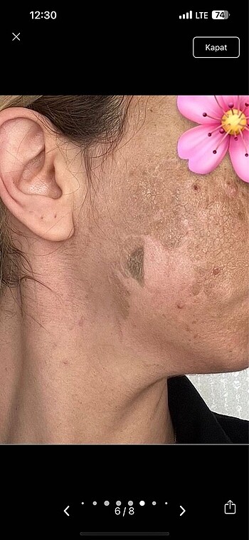 Yosun peeling mesonatural - Görsel 7