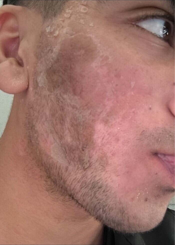 Yosun peeling mesonatural - Görsel 4