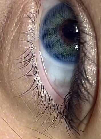 3 aylık mavi lens