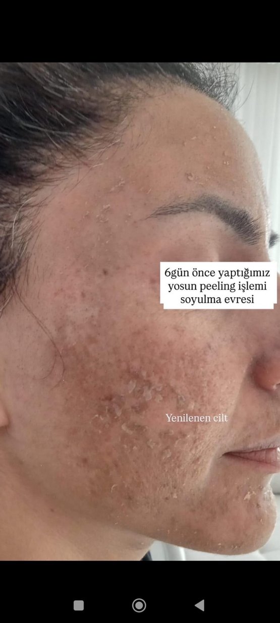 Yosun Peeling tek kullanımlık - Görsel 2