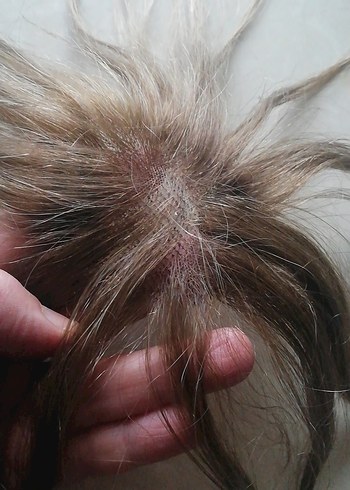 Tepelik saç - Görsel 2