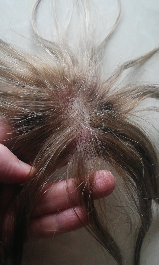 Tepelik saç - Görsel 2