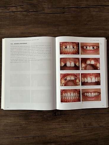  Beden Renk Implants in the Esthetic Zone: A Step-by-Step Treatment Strategy