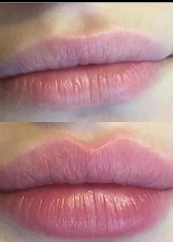 Elasty Göz Altı Dolgu - Görsel 5