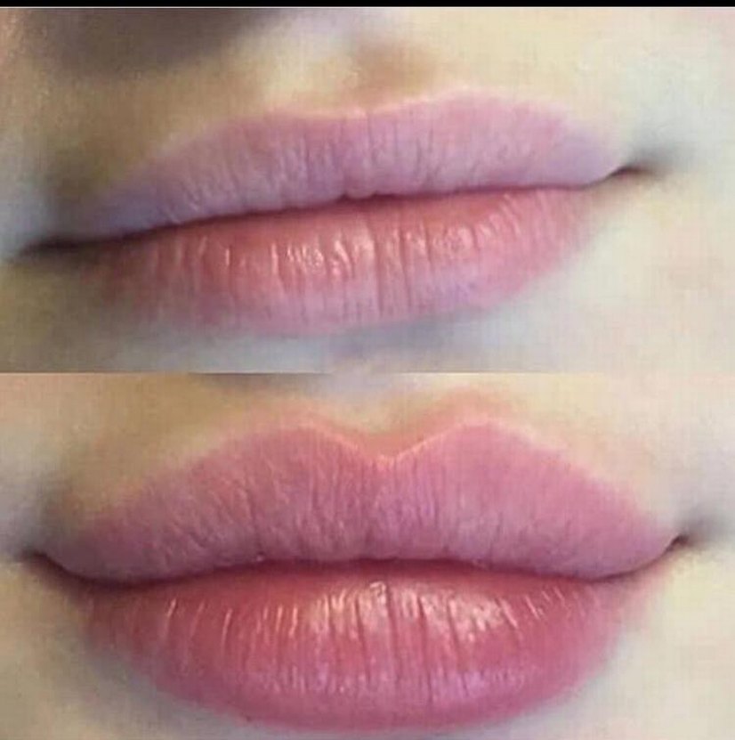 Elasty Göz Altı Dolgu - Görsel 5