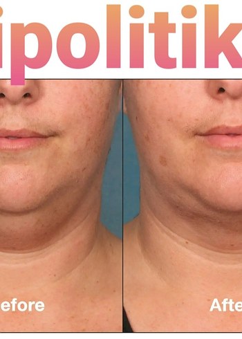 Lipo Lab lipoliz - Görsel 5