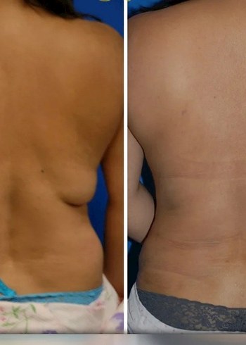 Lipo Lab lipoliz - Görsel 6