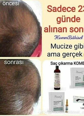 Saç dökülmesi son