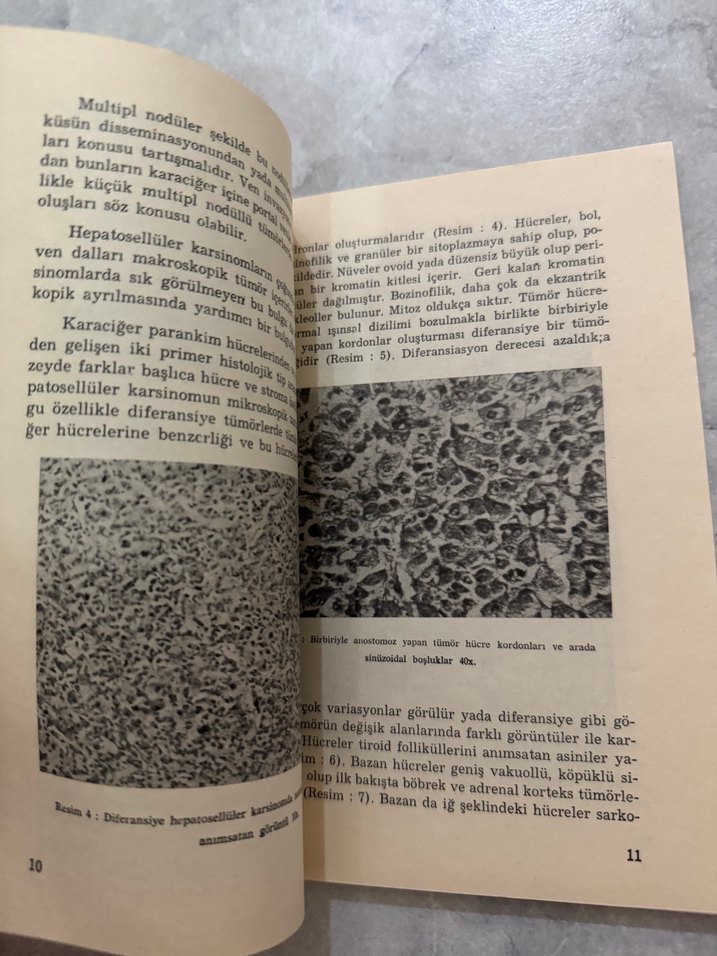 Karaciğer Tümörleri - Görsel 2