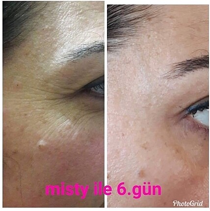  Beden Gano Misty Botox Serum