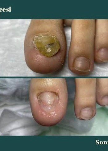 mantar egzama kötü koku  kaşıntı
bitkisel malzemelerden yapili - Görsel 3