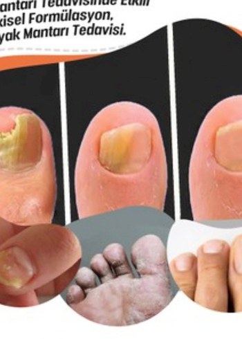 mantar egzama kötü koku  kaşıntı
bitkisel malzemelerden yapili - Görsel 5