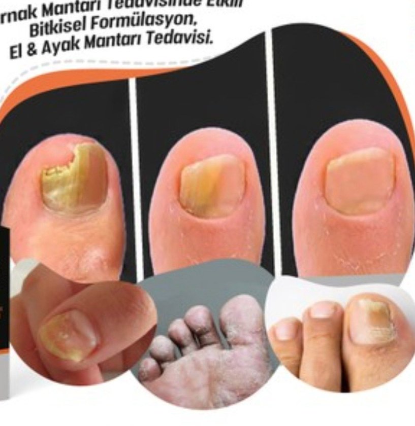 mantar egzama kötü koku  kaşıntı
bitkisel malzemelerden yapili - Görsel 5