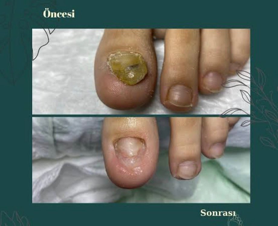 mantar egzama kaşıntı  kötü koku  100% yok edecek. bitkisel krem - Görsel 3