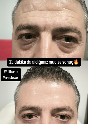 Welltures MiracleWell Anında Kırışıklık Karşıtı Serum - Görsel 4