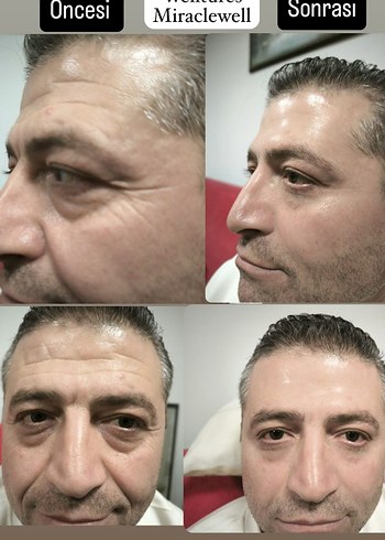 Welltures MiracleWell Anında Kırışıklık Karşıtı Serum - Görsel 7