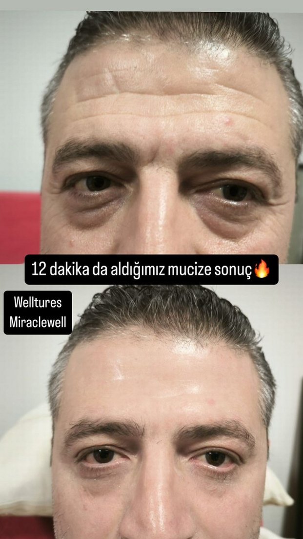 Welltures MiracleWell Anında Kırışıklık Karşıtı Serum - Görsel 4