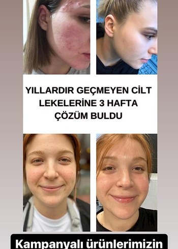 Akne İzleri İçin Cilt Bakım Ürünü serum 900 tl - Görsel 6