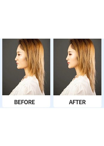 Kaş Germe Göz Germe Yüz Gerdirme İpli Toka Çekik Göz - Görsel 3