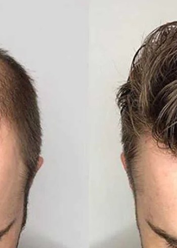 protez saç - Görsel 2