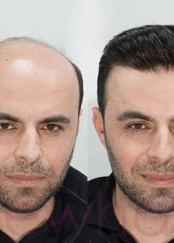 protez saç - Görsel 3