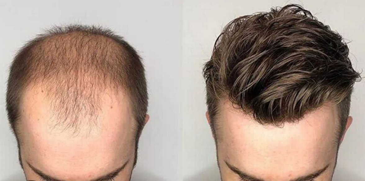 protez saç - Görsel 2