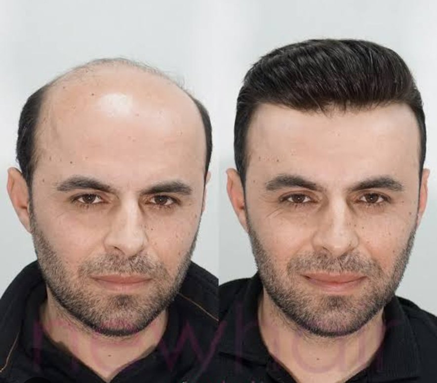 protez saç - Görsel 3