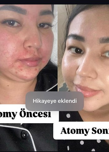 Atomy Cilt Bakım Seti - Akne Azaltıcı - Görsel 2
