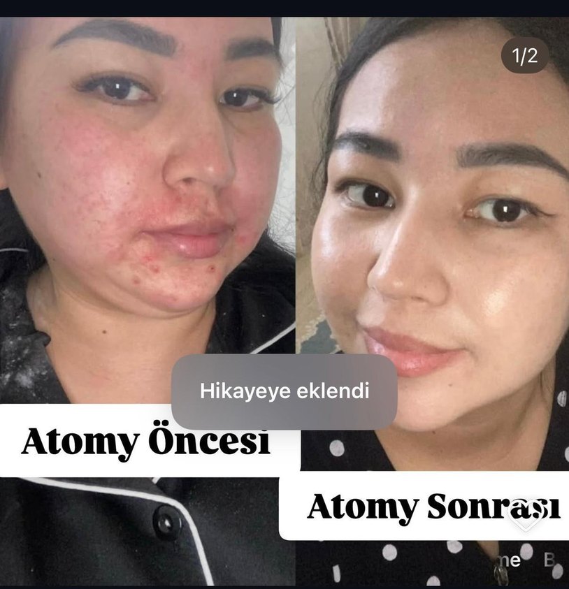 Atomy Cilt Bakım Seti - Akne Azaltıcı - Görsel 2