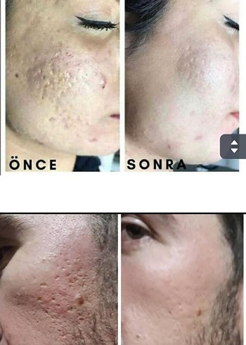 Erkek Saç Serumu ve Maskesi - 1 Aylık Kullanım Sonucu - Görsel 6