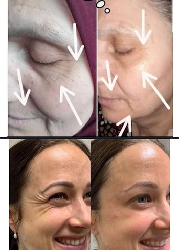 Erkek Saç Serumu ve Maskesi - 1 Aylık Kullanım Sonucu - Görsel 10