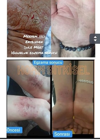 Erkek Saç Serumu ve Maskesi - 1 Aylık Kullanım Sonucu - Görsel 7