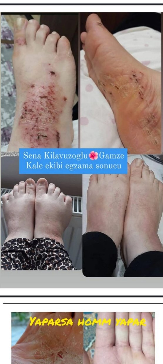 Erkek Saç Serumu ve Maskesi - 1 Aylık Kullanım Sonucu - Görsel 4