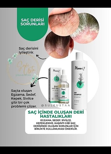  Beden Kepek karsiti serum