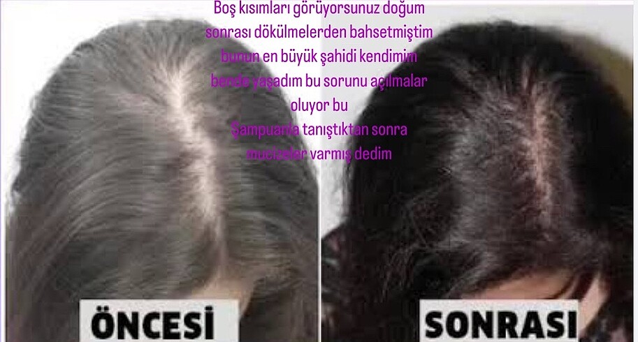 Saç dökülme karşıtı saç çıkaran şampuan - Görsel 9