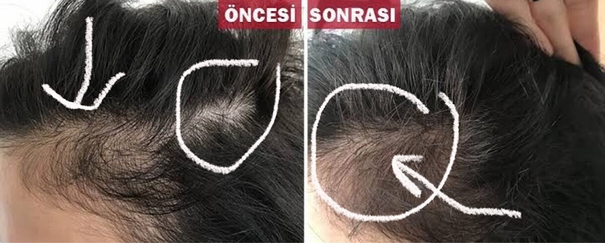 Saç dökülme karşıtı saç çıkaran şampuan - Görsel 7