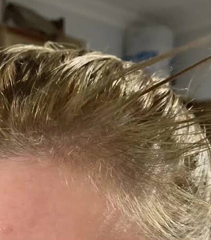 Saç dökülme karşıtı saç çıkaran şampuan - Görsel 11