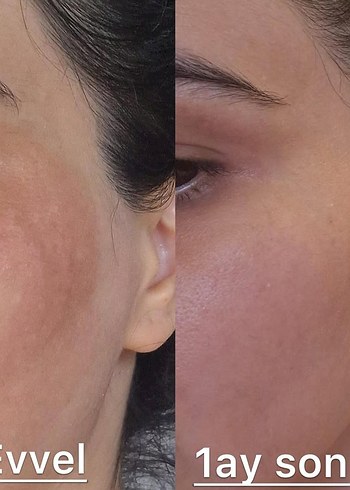 Leke kremi - Görsel 4