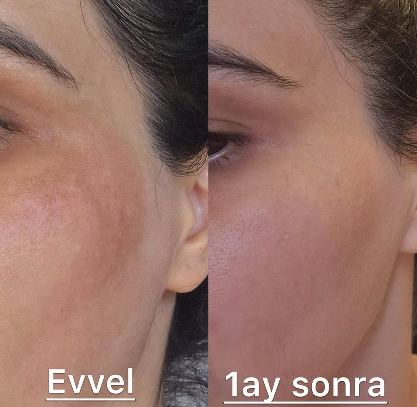 Leke kremi - Görsel 4