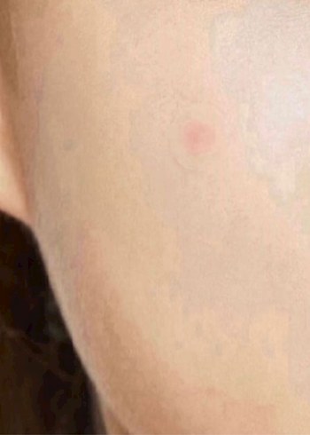 Cosrx Acne Pimple Master Patch - Görsel 5